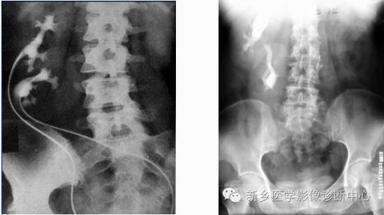 肾脏异位 肾脏异位