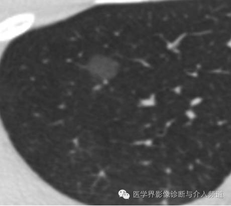 肺部磨玻璃影结节早期诊断 肺部磨玻璃影结节早期诊断