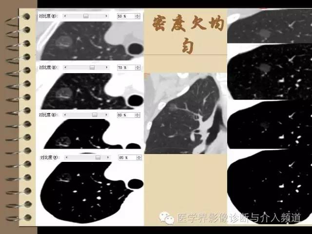 肺部磨玻璃影结节早期诊断 肺部磨玻璃影结节早期诊断