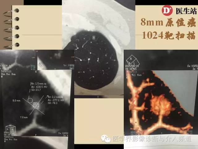 肺部磨玻璃影结节早期诊断 肺部磨玻璃影结节早期诊断