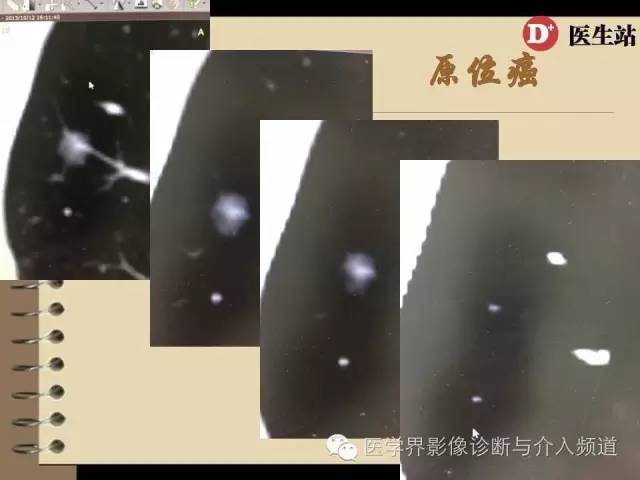 肺部磨玻璃影结节早期诊断 肺部磨玻璃影结节早期诊断
