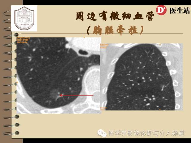 肺部磨玻璃影结节早期诊断 肺部磨玻璃影结节早期诊断