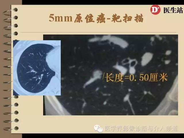 肺部磨玻璃影结节早期诊断 肺部磨玻璃影结节早期诊断