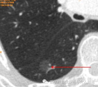 肺部磨玻璃影结节早期诊断