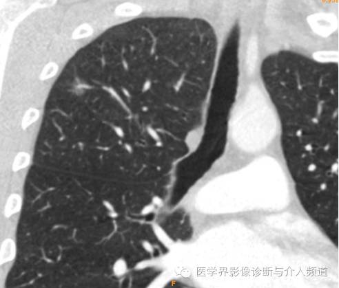 肺部磨玻璃影结节早期诊断 肺部磨玻璃影结节早期诊断