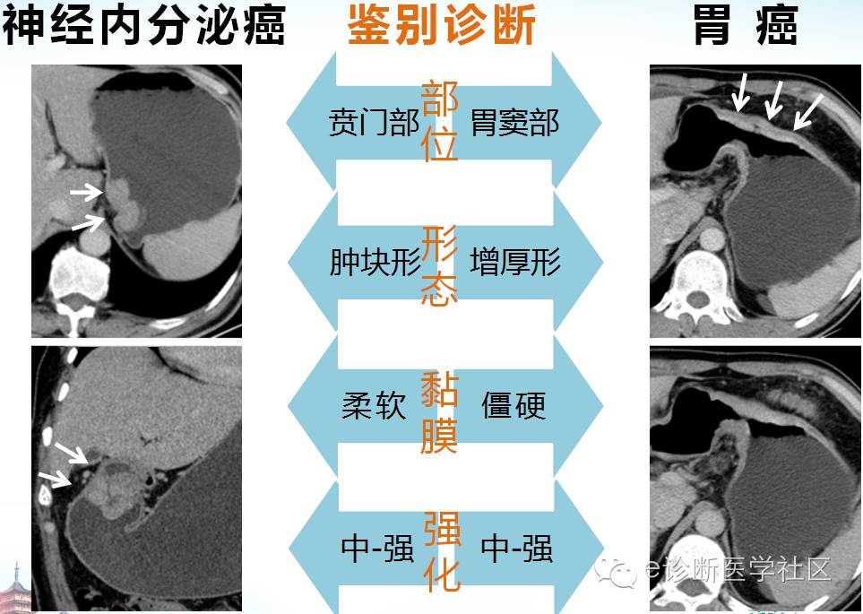 胃部少见原发肿瘤的CT诊断 胃部少见原发肿瘤的CT诊断