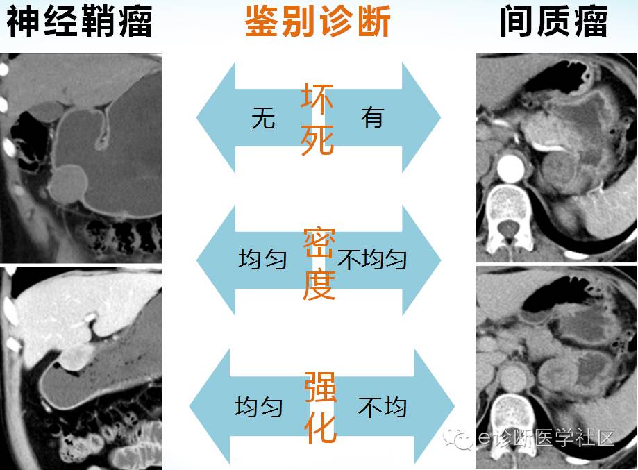 胃部少见原发肿瘤的CT诊断 胃部少见原发肿瘤的CT诊断