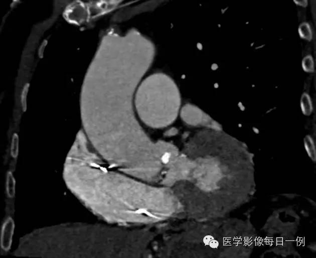 【病例】退行性钙化性主动脉瓣狭窄1例CT影像表现