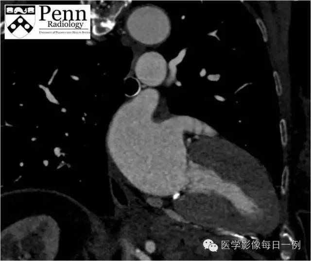 【病例】退行性钙化性主动脉瓣狭窄1例CT影像表现 【病例】退行性钙化性主动脉瓣狭窄1例CT影像表现