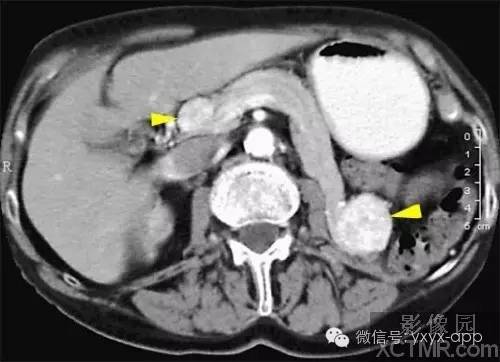胰腺内分泌肿瘤影像诊断