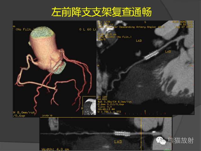 【PPT】冠状动脉支架及搭桥术后的评估