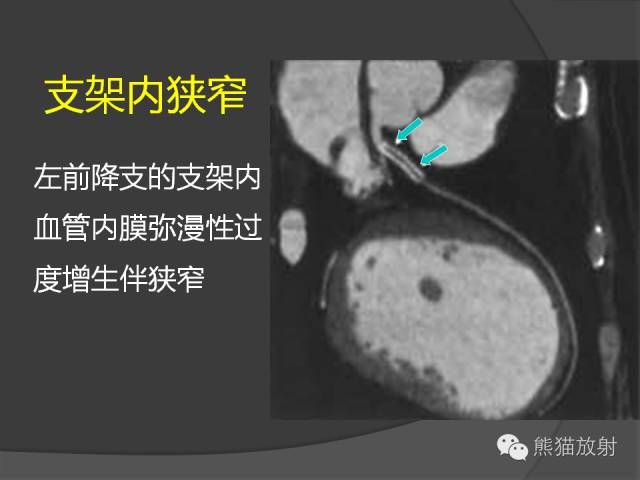 【PPT】冠状动脉支架及搭桥术后的评估