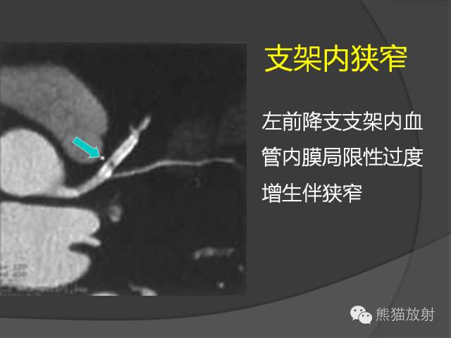 【PPT】冠状动脉支架及搭桥术后的评估