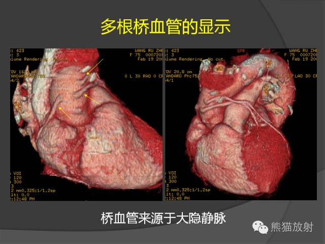 【PPT】冠状动脉支架及搭桥术后的评估