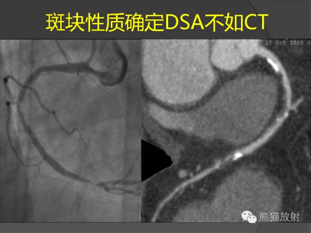 【PPT】冠状动脉支架及搭桥术后的评估