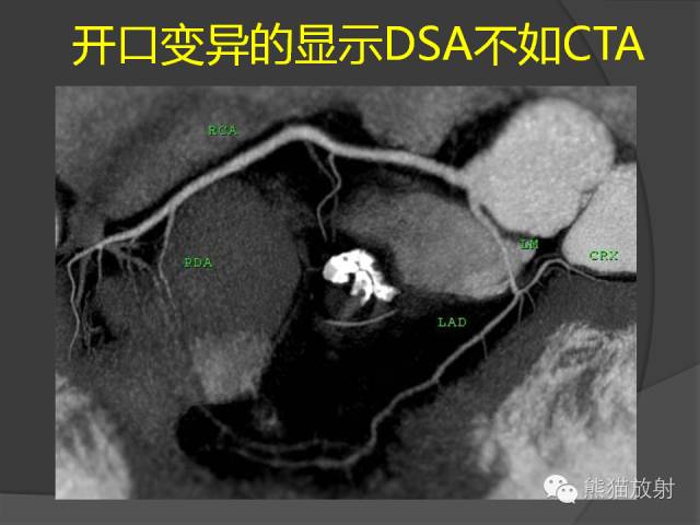 【PPT】冠状动脉支架及搭桥术后的评估