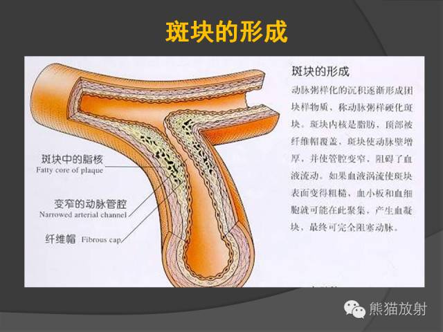 【PPT】冠状动脉支架及搭桥术后的评估