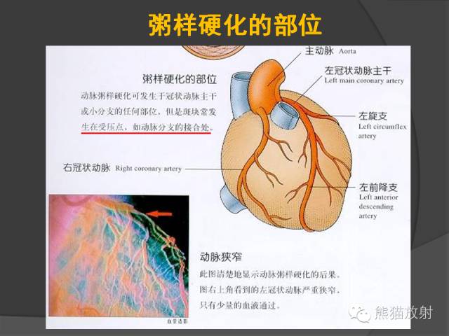 【PPT】冠状动脉支架及搭桥术后的评估