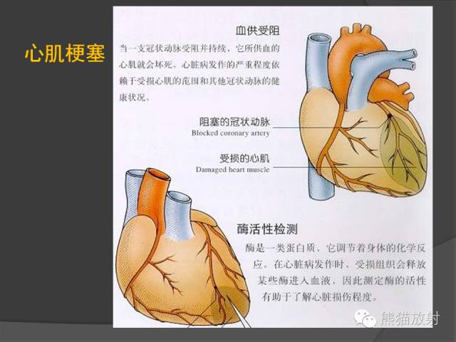 【PPT】冠状动脉支架及搭桥术后的评估