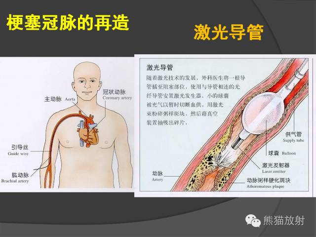 【PPT】冠状动脉支架及搭桥术后的评估