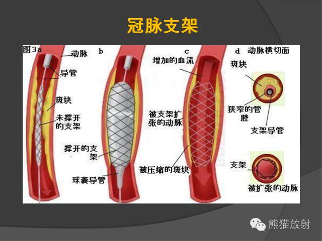 【PPT】冠状动脉支架及搭桥术后的评估