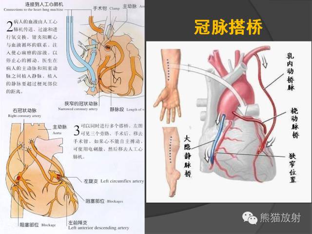 【PPT】冠状动脉支架及搭桥术后的评估