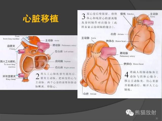 【PPT】冠状动脉支架及搭桥术后的评估