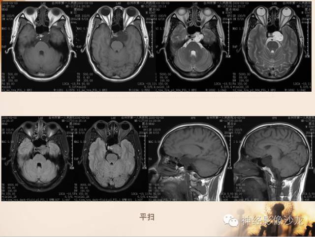 【病例】鞍旁脊索瘤1例CT及MR影像表现