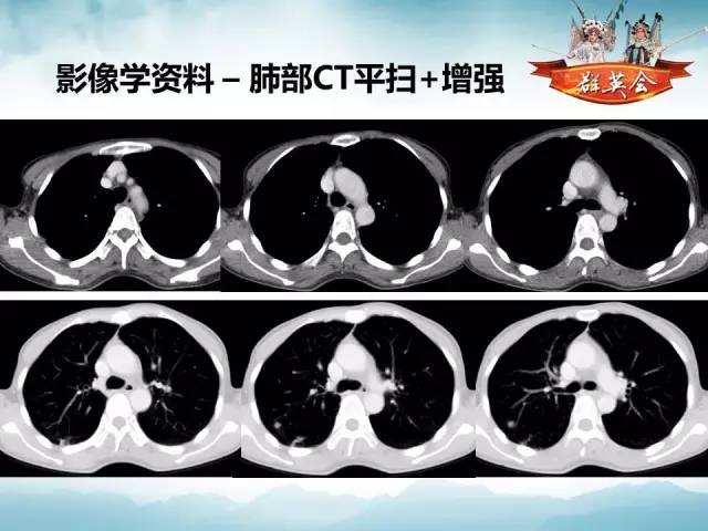 【病例】肺隐球菌病1例CT影像表现