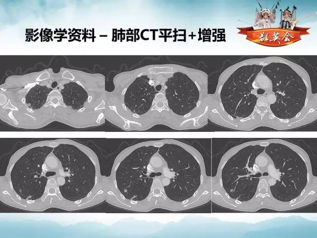 【病例】肺隐球菌病1例CT影像表现