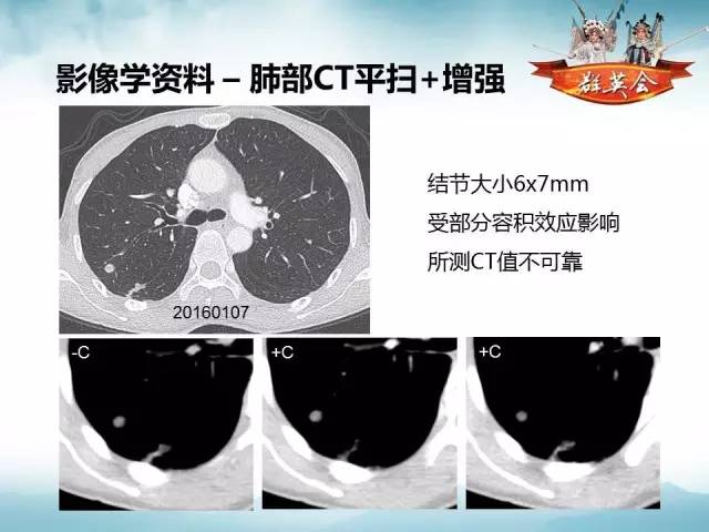【病例】肺隐球菌病1例CT影像表现