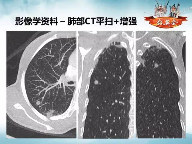 【病例】肺隐球菌病1例CT影像表现