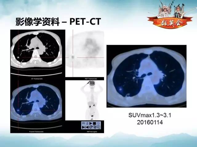 【病例】肺隐球菌病1例CT影像表现