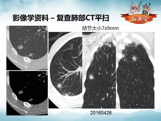 【病例】肺隐球菌病1例CT影像表现