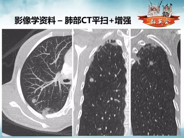 【病例】肺隐球菌病1例CT影像表现