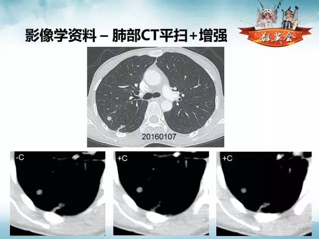 【病例】肺隐球菌病1例CT影像表现