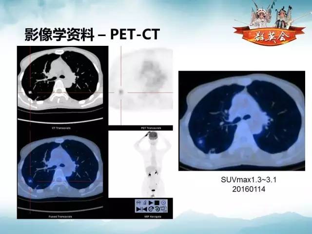 【病例】肺隐球菌病1例CT影像表现