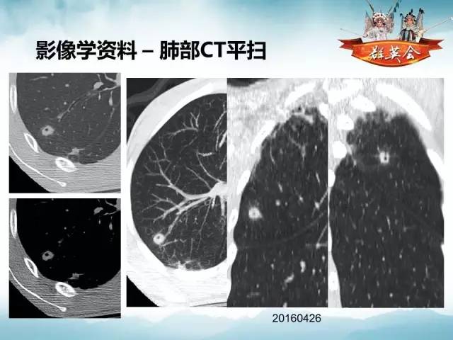 【病例】肺隐球菌病1例CT影像表现