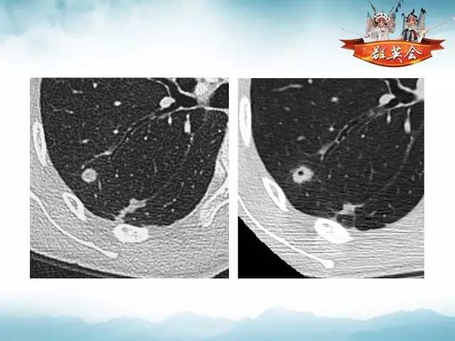 【病例】肺隐球菌病1例CT影像表现