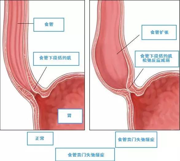 【病例】贲门失弛缓症例CT影像表现 【病例】贲门失弛缓症例CT影像表现