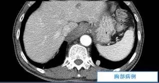 【病例】贲门失弛缓症例CT影像表现 【病例】贲门失弛缓症例CT影像表现