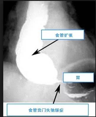 【病例】贲门失弛缓症例CT影像表现 【病例】贲门失弛缓症例CT影像表现