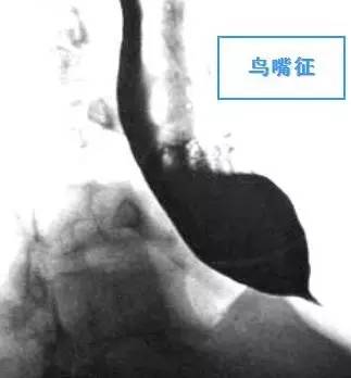 【病例】贲门失弛缓症例CT影像表现 【病例】贲门失弛缓症例CT影像表现