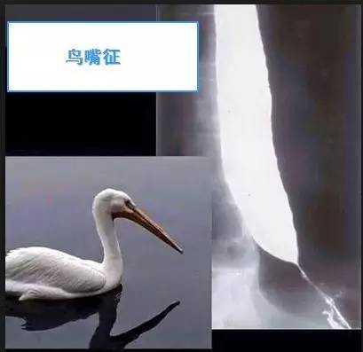【病例】贲门失弛缓症例CT影像表现 【病例】贲门失弛缓症例CT影像表现