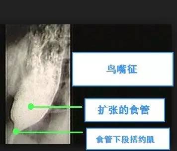 【病例】贲门失弛缓症例CT影像表现 【病例】贲门失弛缓症例CT影像表现