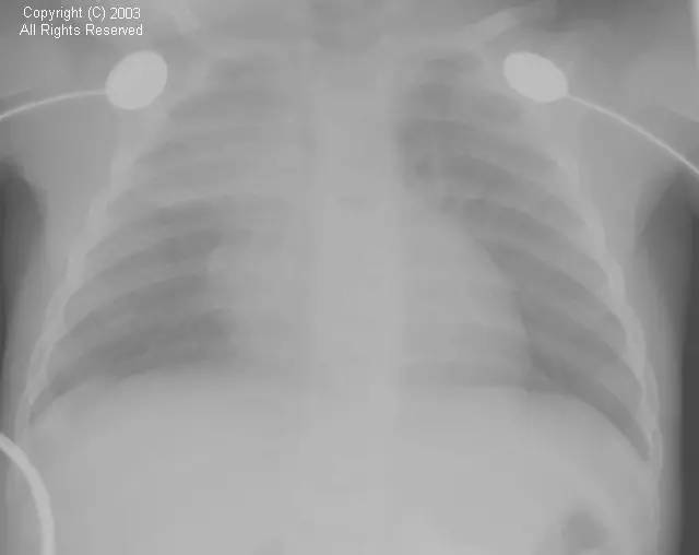 【病例】这样的胸腺你认识吗? 【病例】这样的胸腺你认识吗?