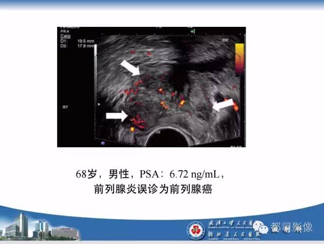 【PPT】前列腺癌高分辨率DWI临床应用