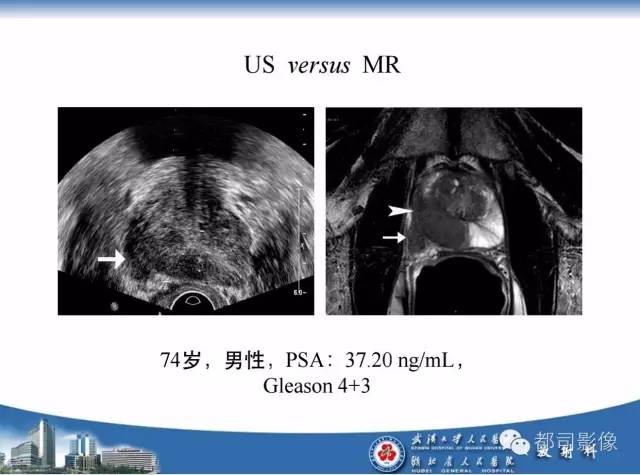 【PPT】前列腺癌高分辨率DWI临床应用