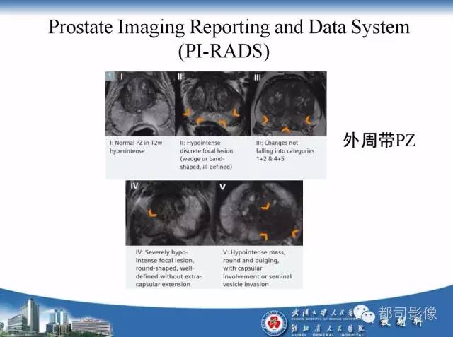 【PPT】前列腺癌高分辨率DWI临床应用