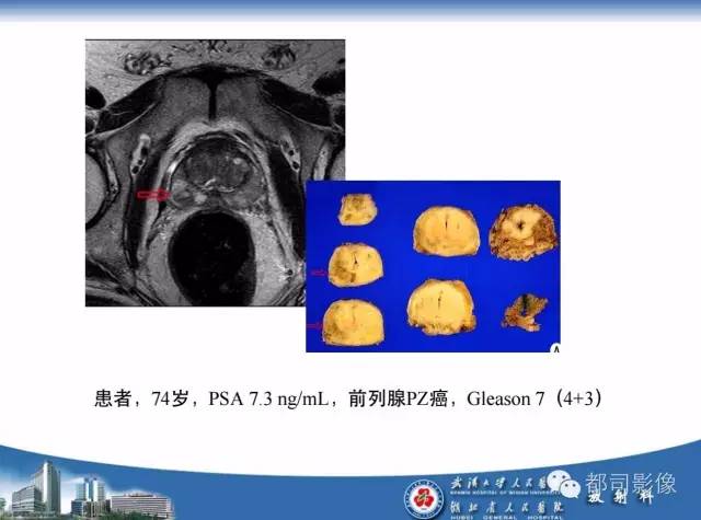 【PPT】前列腺癌高分辨率DWI临床应用